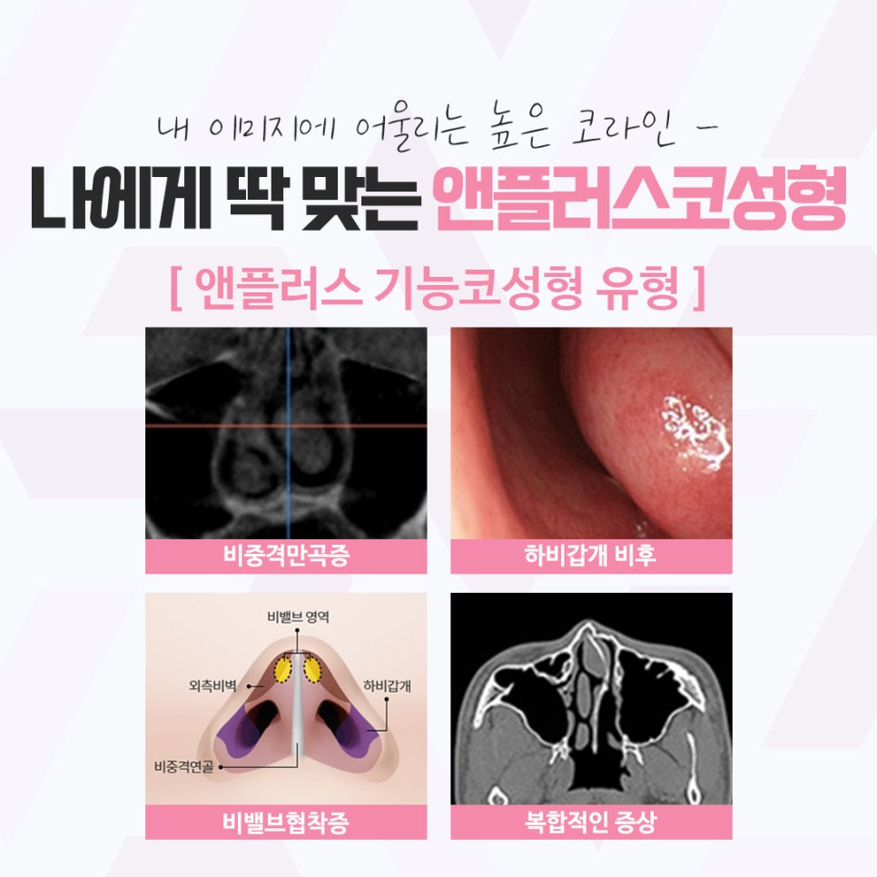 앤플러스의원에서 전해드리는 코성형후기 관련 이미지 5