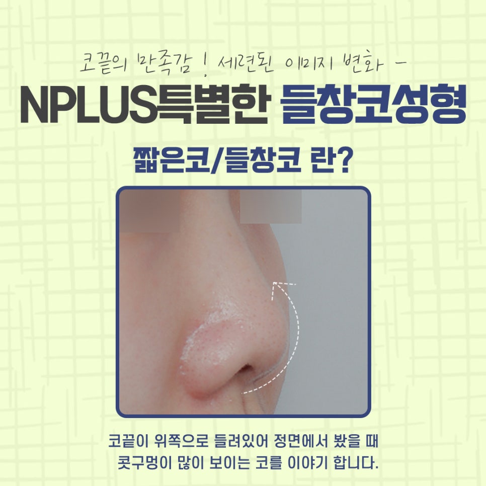 Significantly Improve an Upturned Nose with Surgery image 4