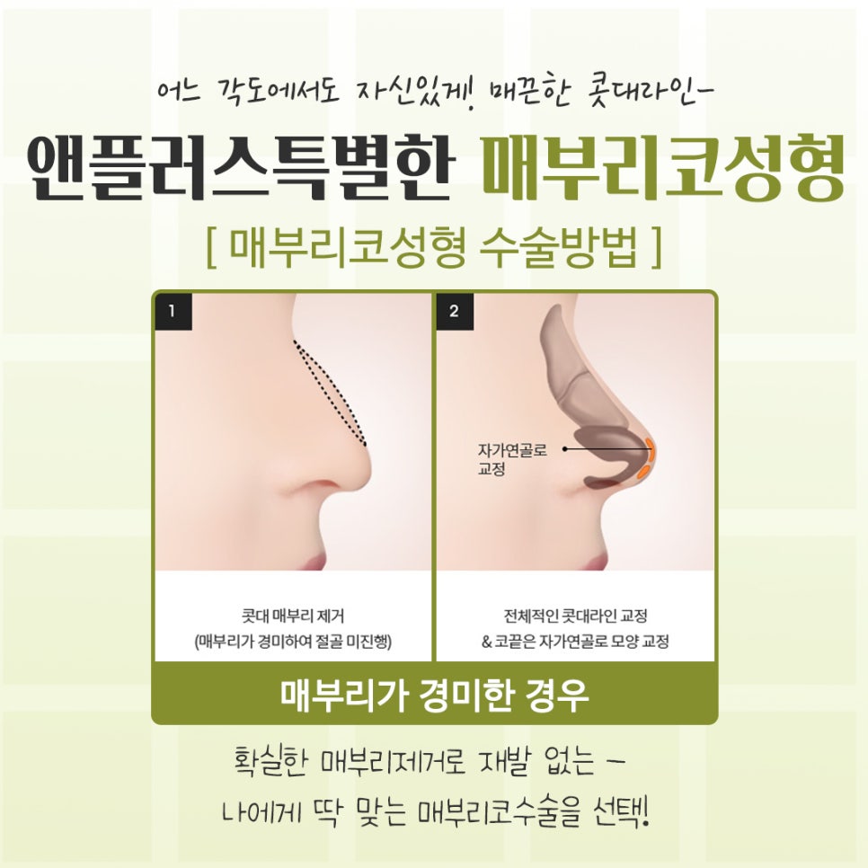 If You’re Looking for Reviews of Hump Nose Surgery image 11