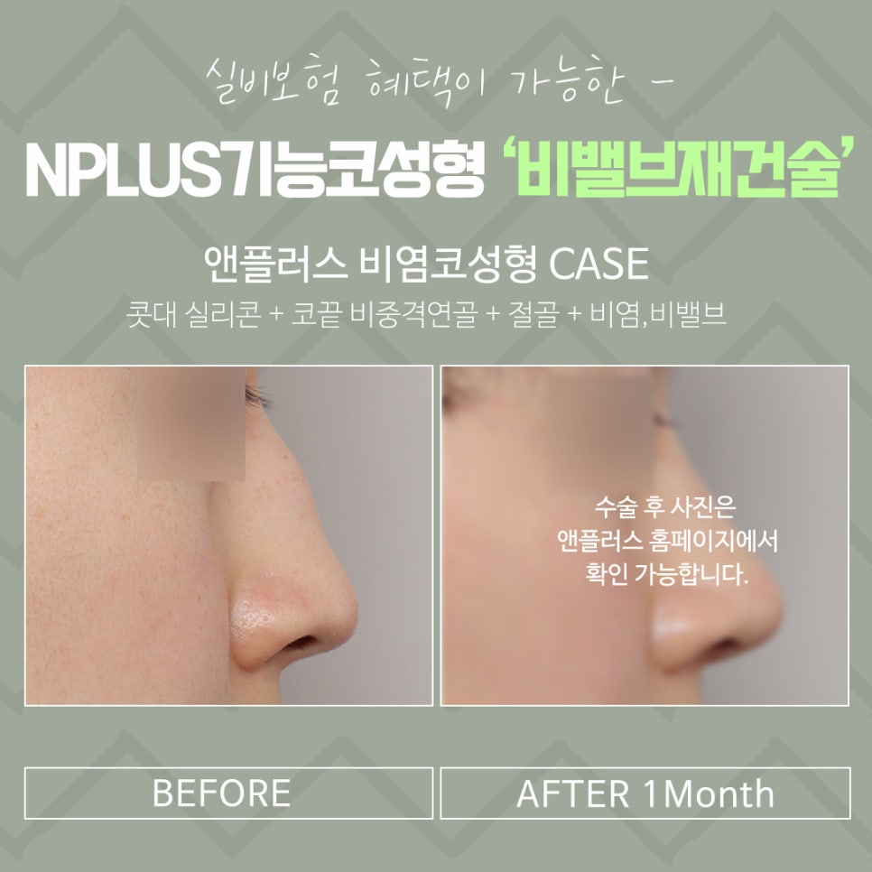 비밸브재건술을 통한 숨 쉬는 자유 관련 이미지 16