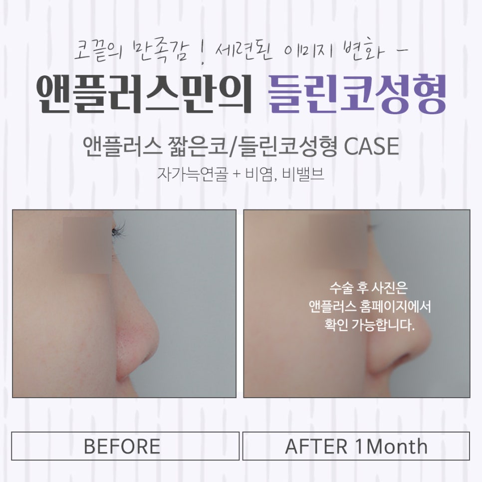 A Clear Correction After Upturned Nose Surgery Review image 16