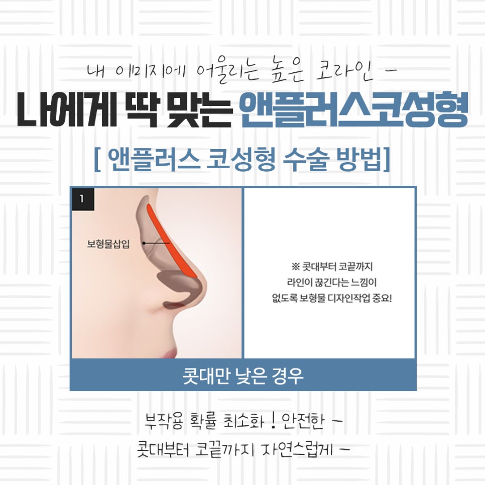 자가연골 이용한 코성형 후기 관련 이미지 9