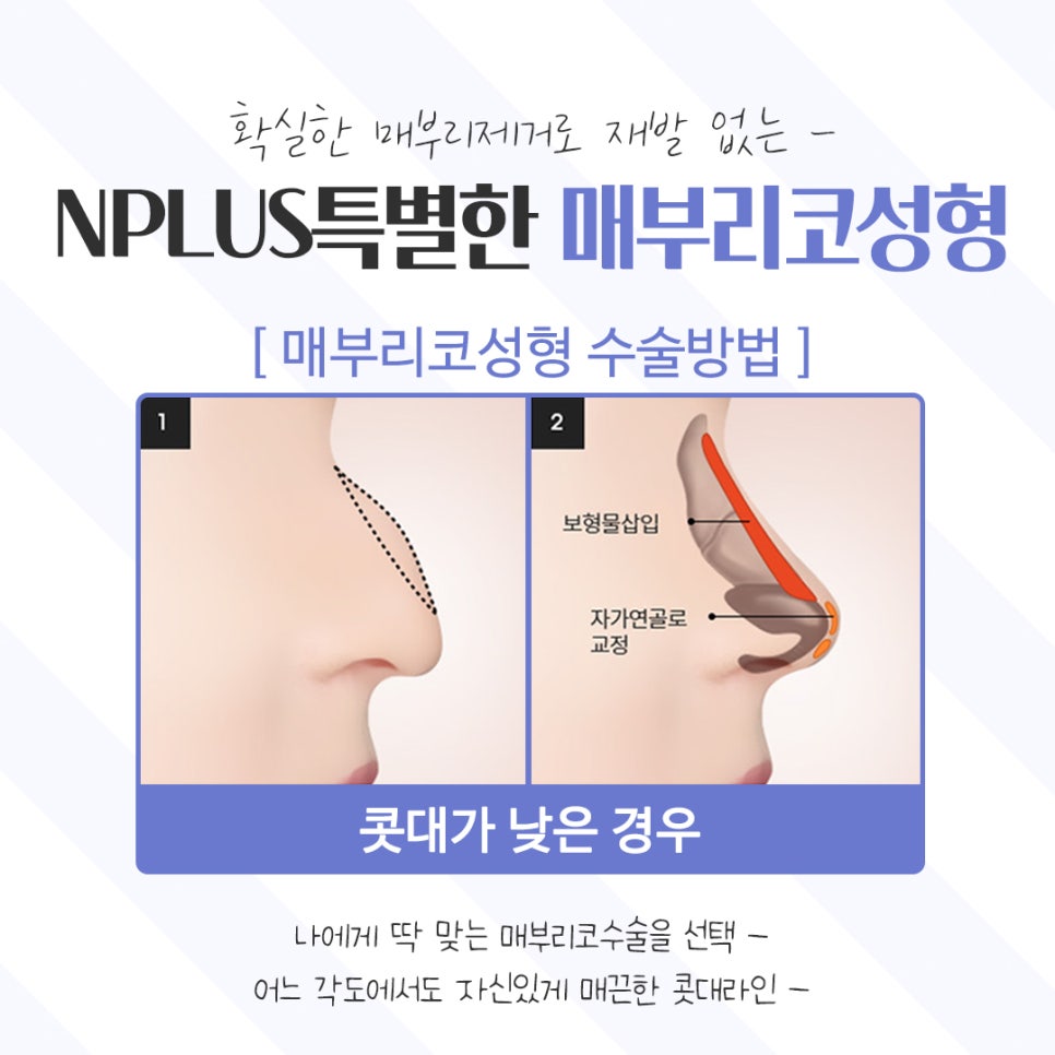 Learn About Hump Nose Surgery Reviews Accurately image 10