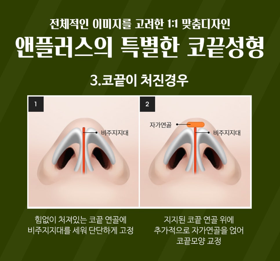 강남코성형 예쁜 코끝성형으로 이미지 개선 관련 이미지 7