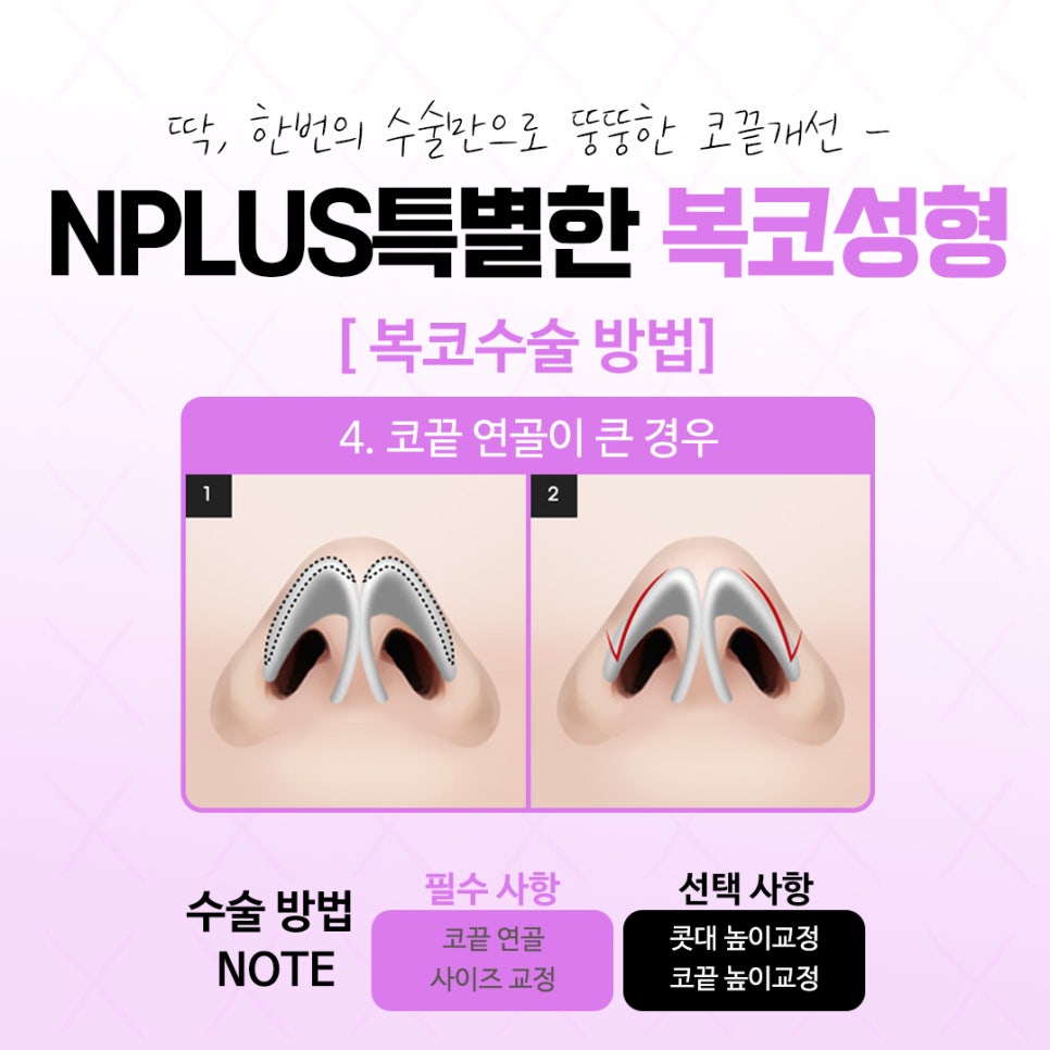 복코수술후기 날렵하고 세련된 라인으로 관련 이미지 10