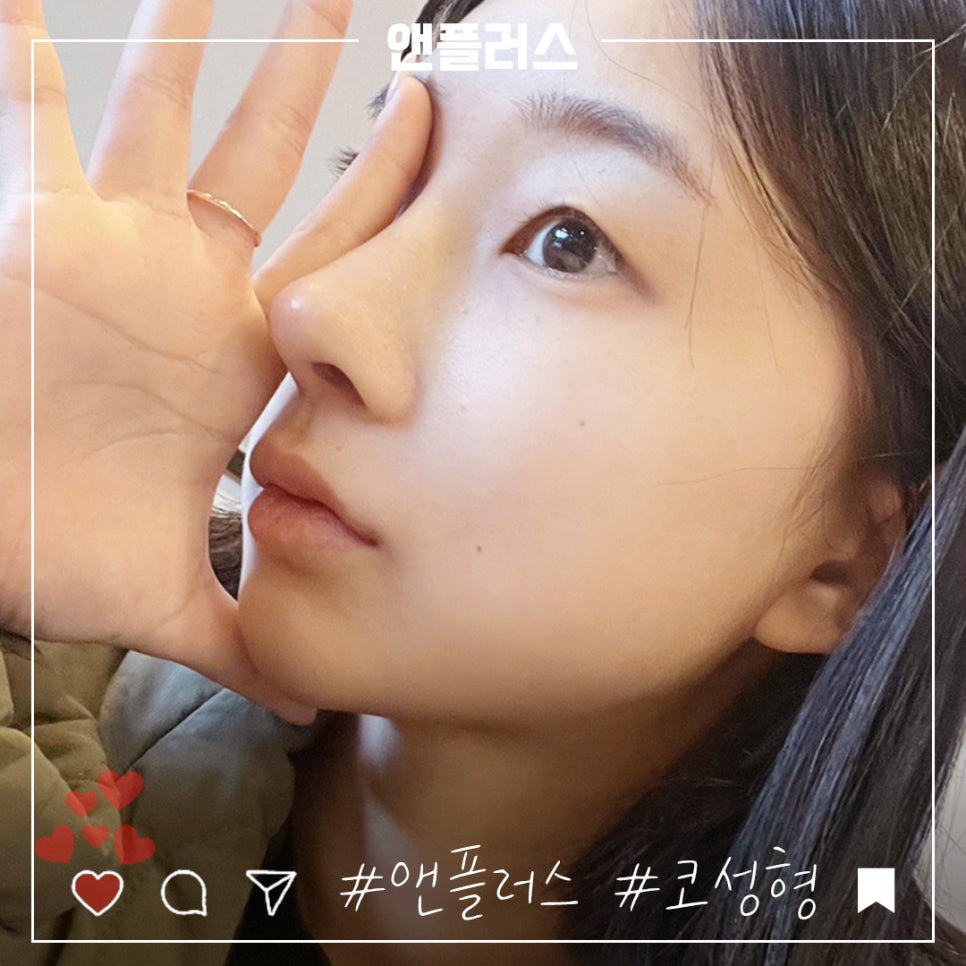 앤플러스의원에서 전해드리는 코성형후기 관련 이미지 1