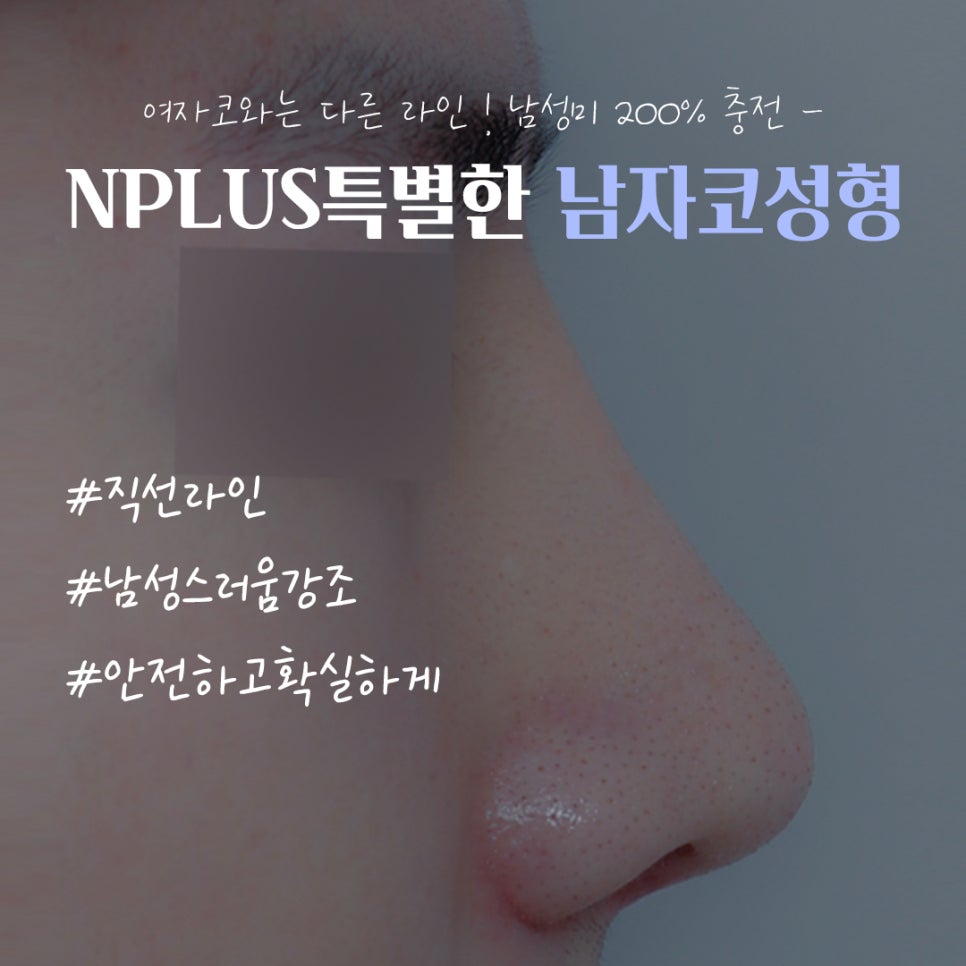 Rhinoplasty Review for Improving a Large Male Nose image 14
