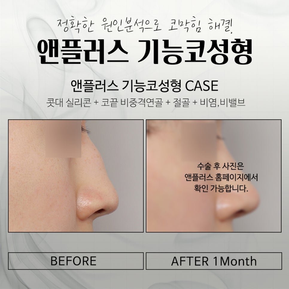 기능코성형실비에 대해 체크하고 관련 이미지 12