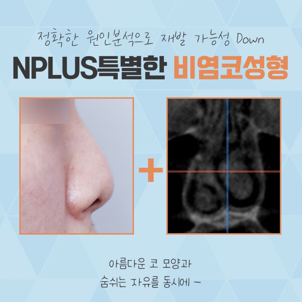 비염수술코성형 한 번의 선택으로 관련 이미지 5