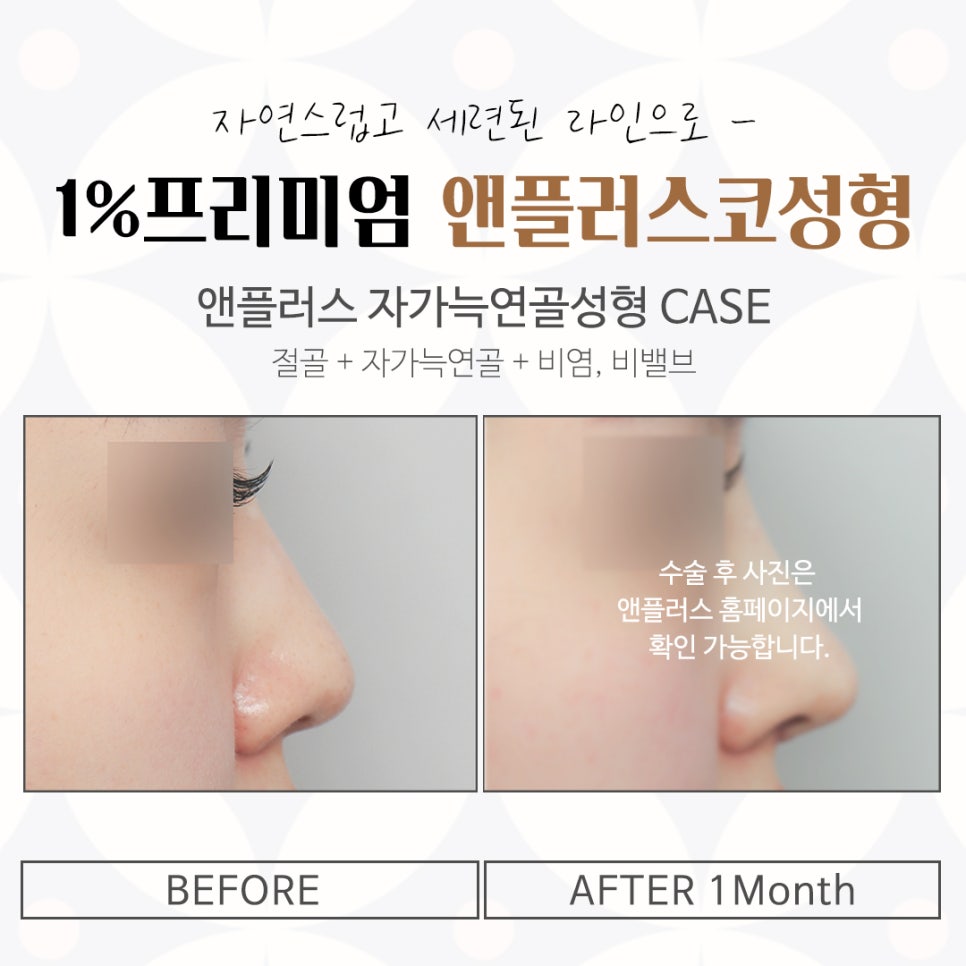 자가늑연골코수술에 대한 내용을 찾는다면 관련 이미지 15