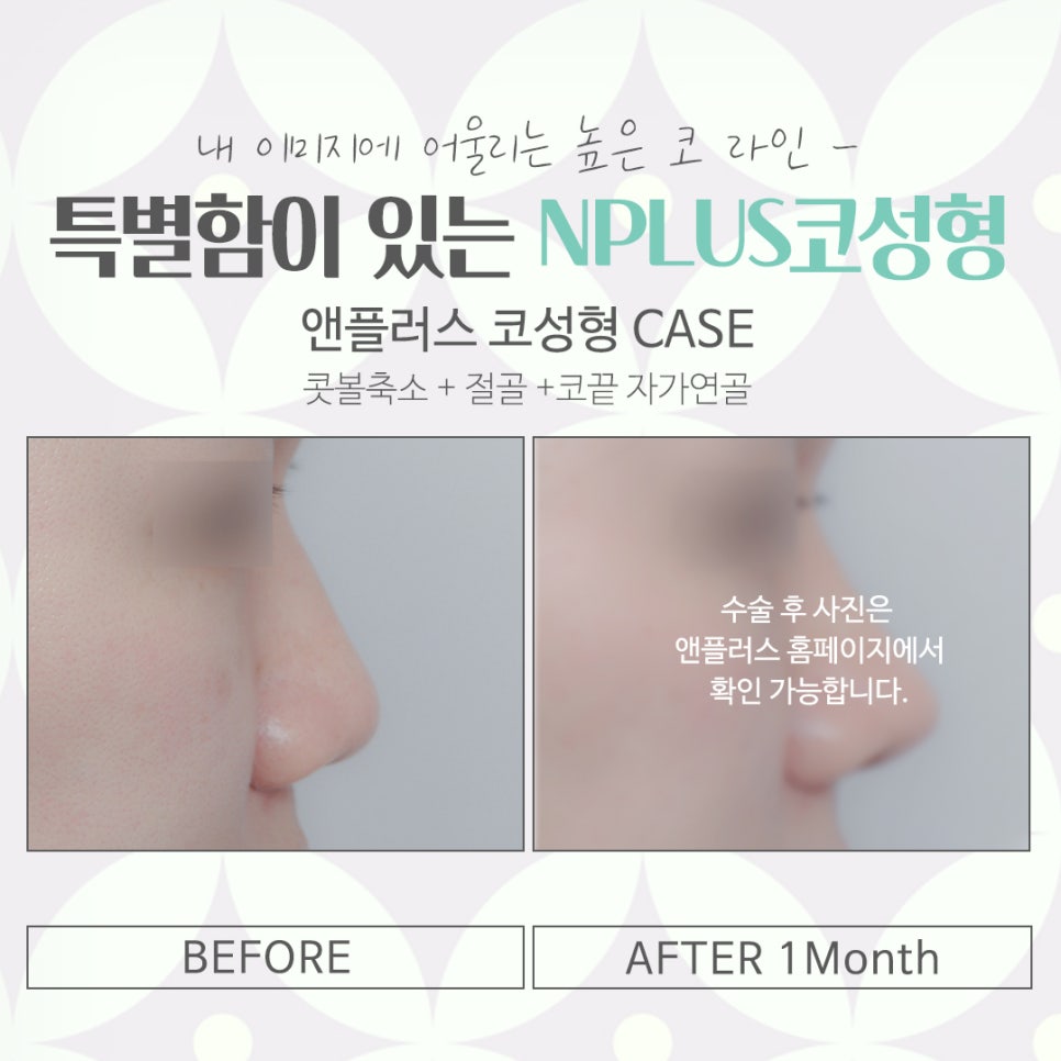 코성형잘하는곳에 대해 비교해 보고 관련 이미지 14