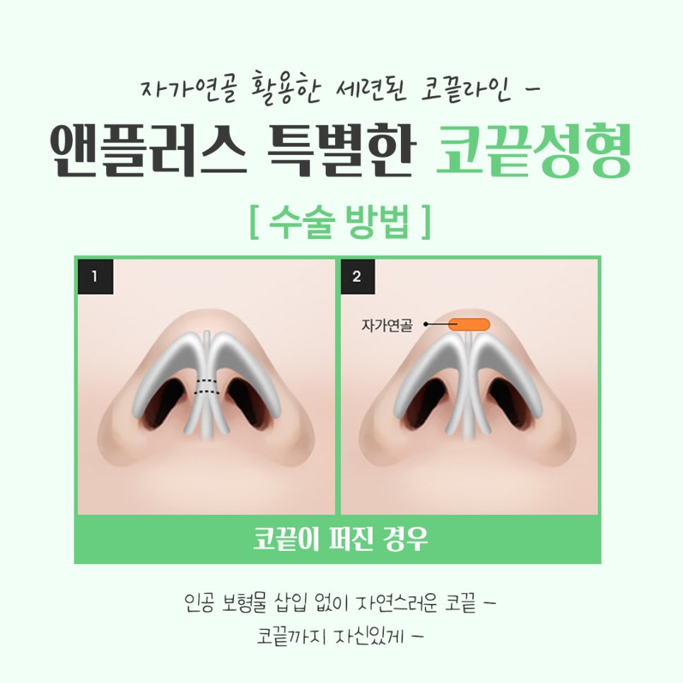 코끝수술후기 자가연골을 통해 자연스럽게 관련 이미지 9
