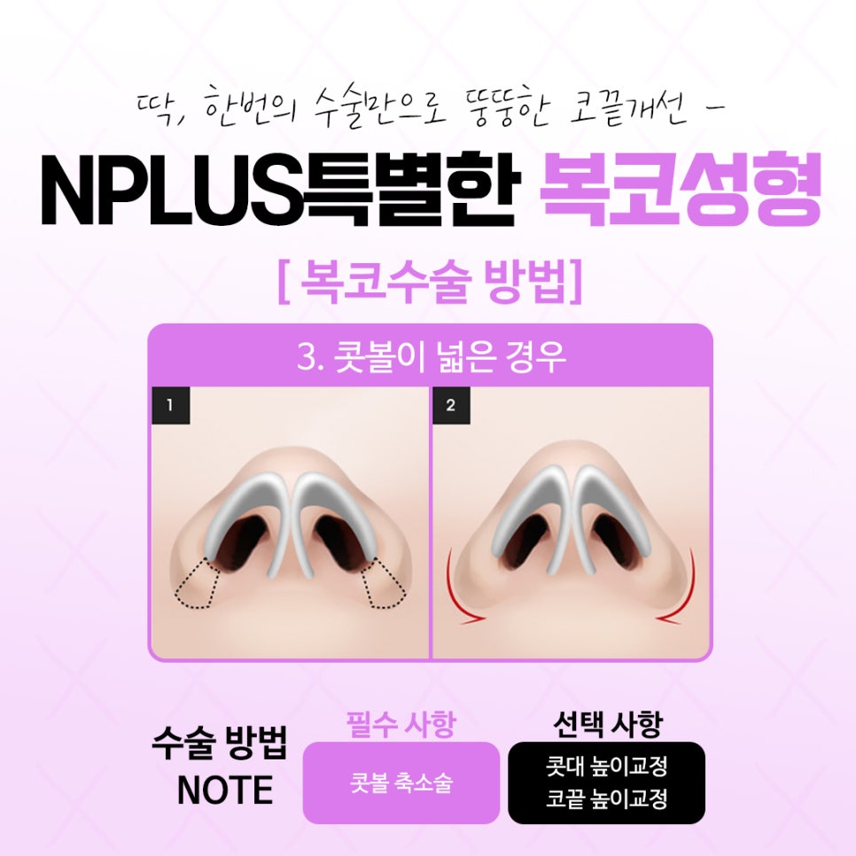 복코수술후기 날렵하고 세련된 라인으로 관련 이미지 9