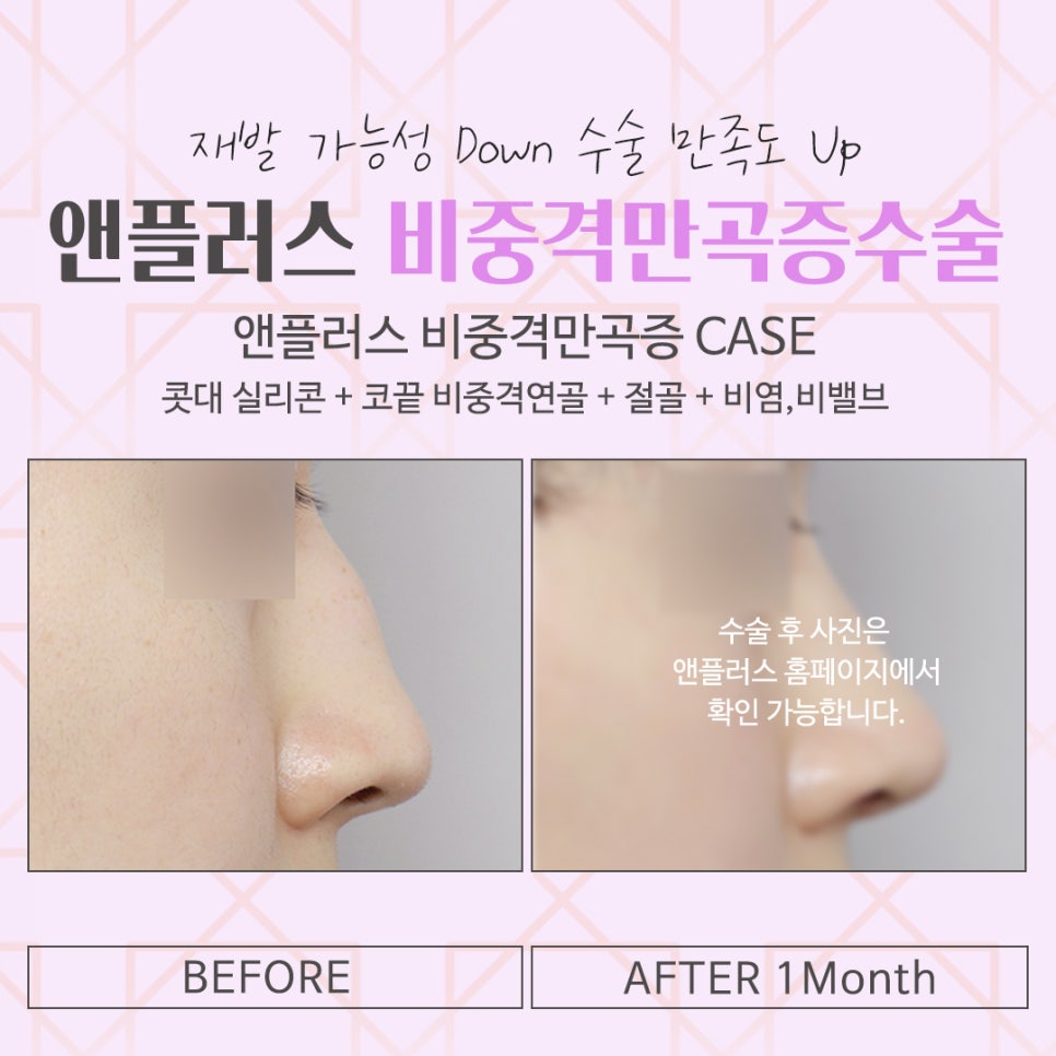 비중격만곡증수술후기 원인과 해결 방법까지 관련 이미지 15