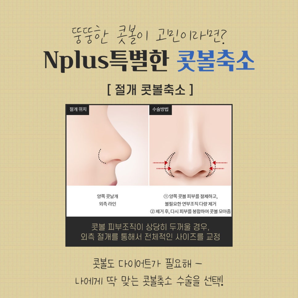 Review of Nostril Reduction to Improve a Wide Nose image 8