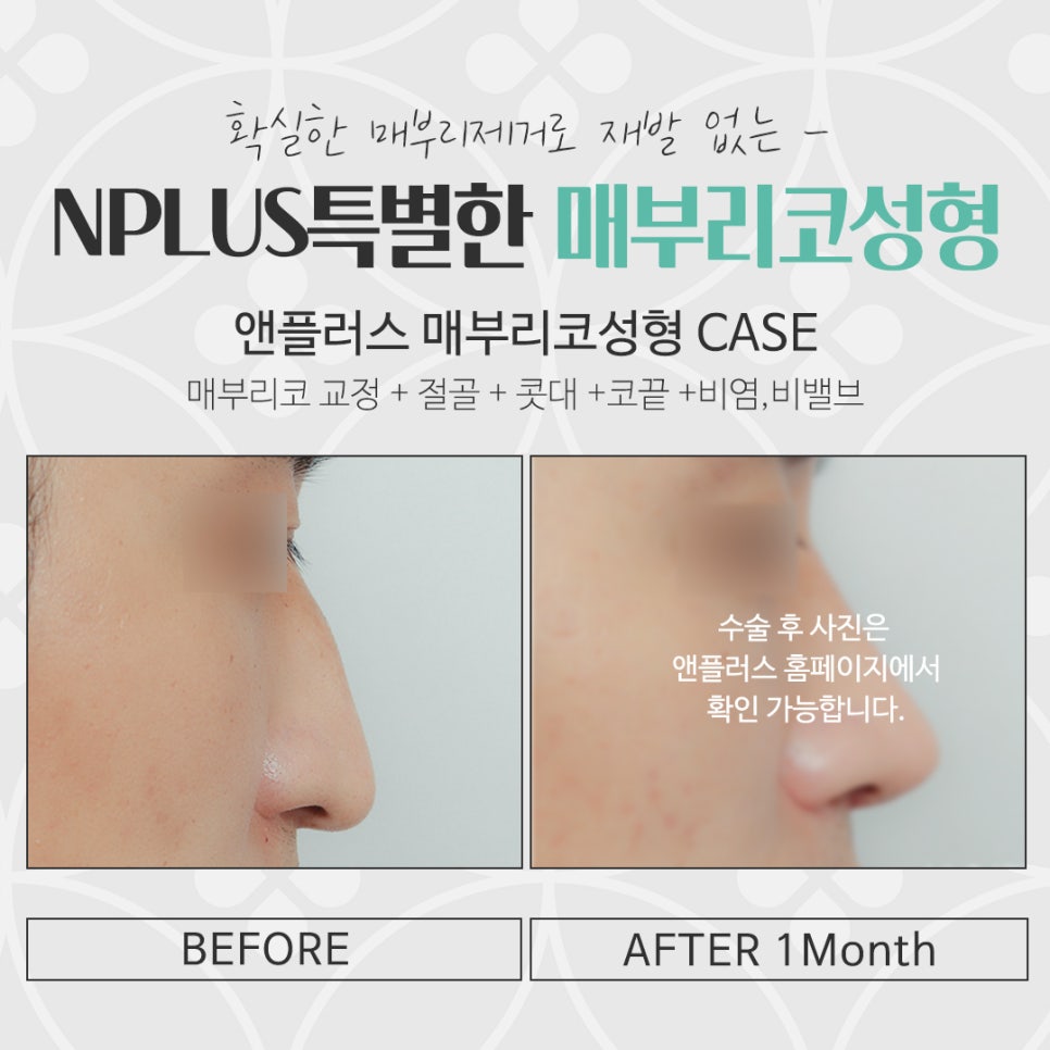매부리코성형후기 부드러운 인상으로 관련 이미지 17