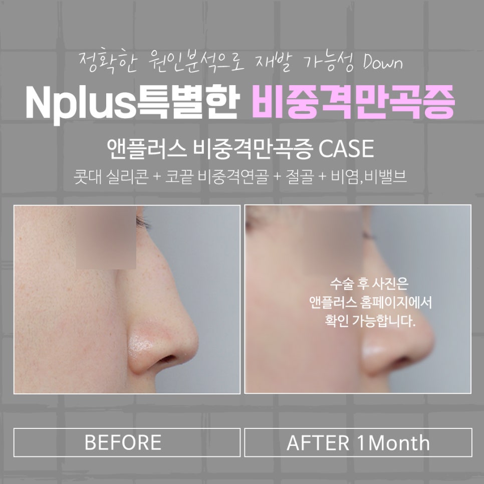 비중격만곡증수술 후기를 알아보고 결정 관련 이미지 15