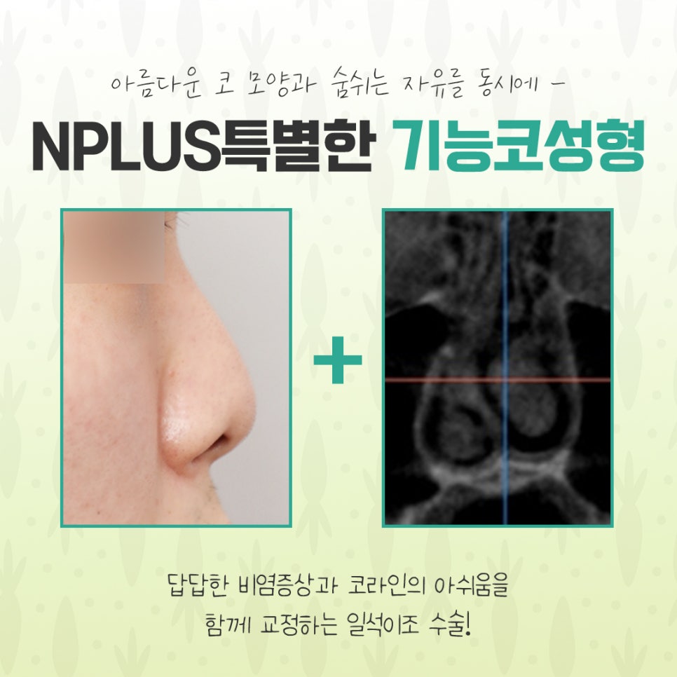 기능코수술후기에 대한 내용을 비교하여 관련 이미지 4