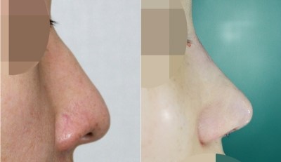 코재수술(콧대 보형물 변형 + 코끝처짐 재교정) 관련 이미지 1