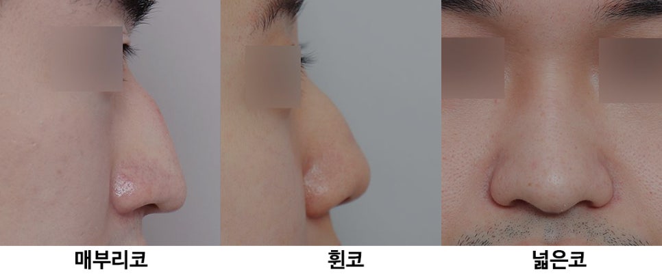 What Is the Prettiest Nose That Suits My Face Best? image 8