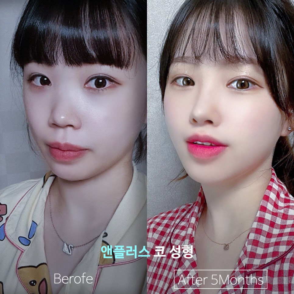 코성형,첫 수술부터 갈비뼈(자가늑연골)로 이식해야 하는 이유 관련 이미지 5