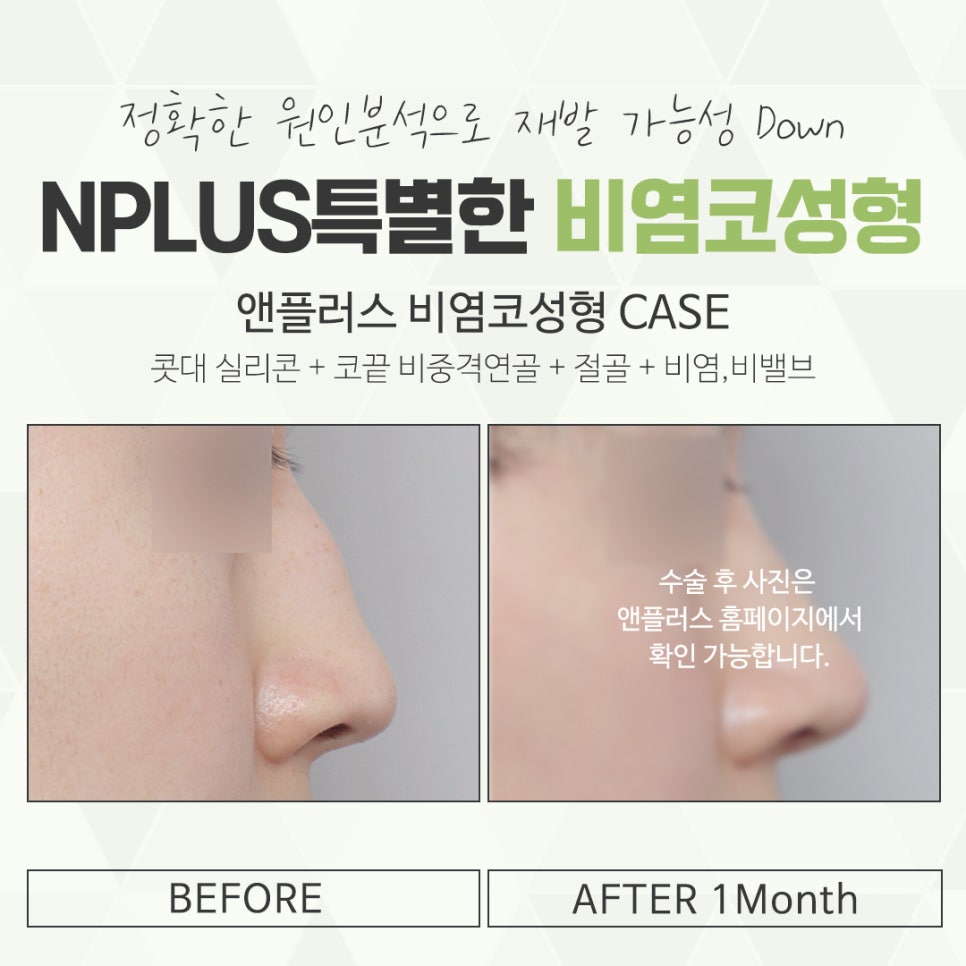 비염수술코성형 다양한 요인을 확인하여 관련 이미지 14