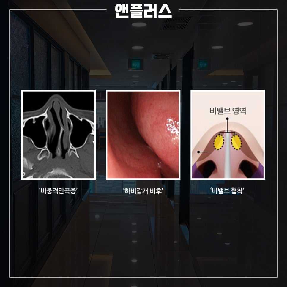 코막힘원인은? 코 안을 잘 봐야 합니다. 관련 이미지 3