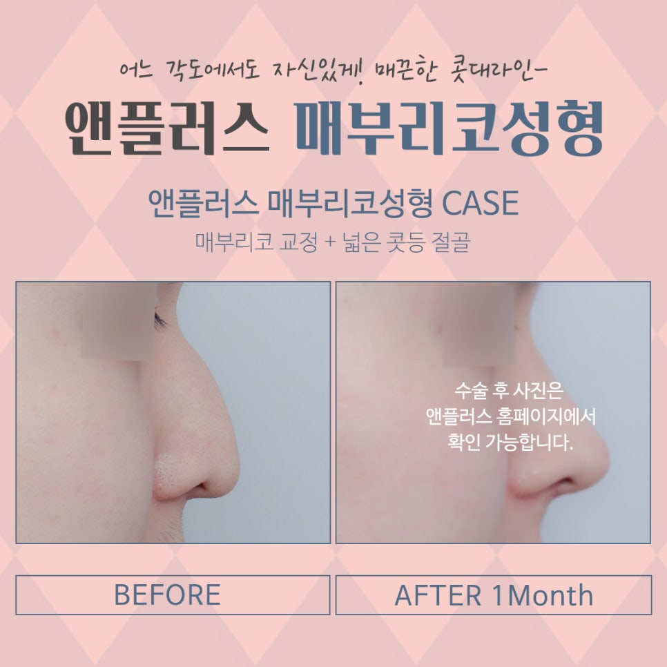 A Smooth Nasal Bridge Line Through Hump Nose Correction image 6