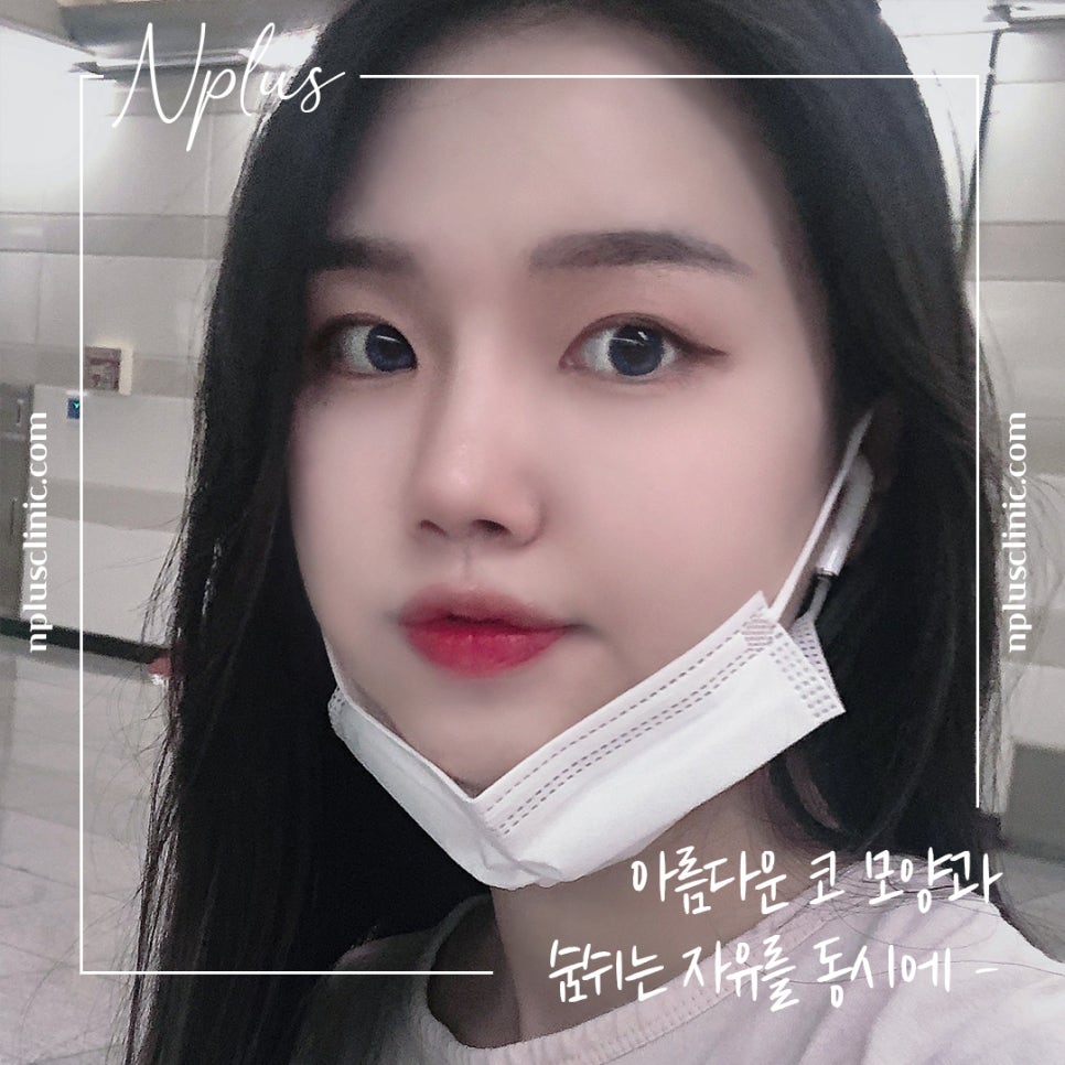 Septoplasty and Hump Nose Surgery Review, Considering Function Too image 16