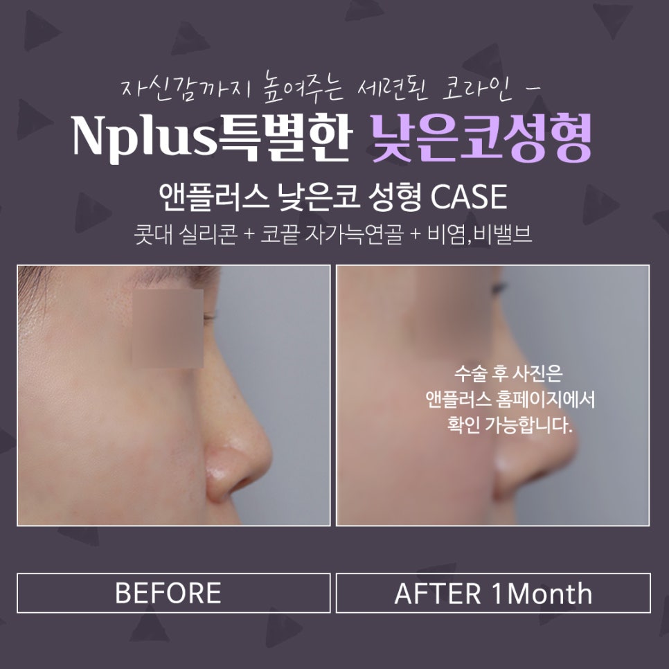 낮은코수술후기 세련된 코라인으로 관련 이미지 3