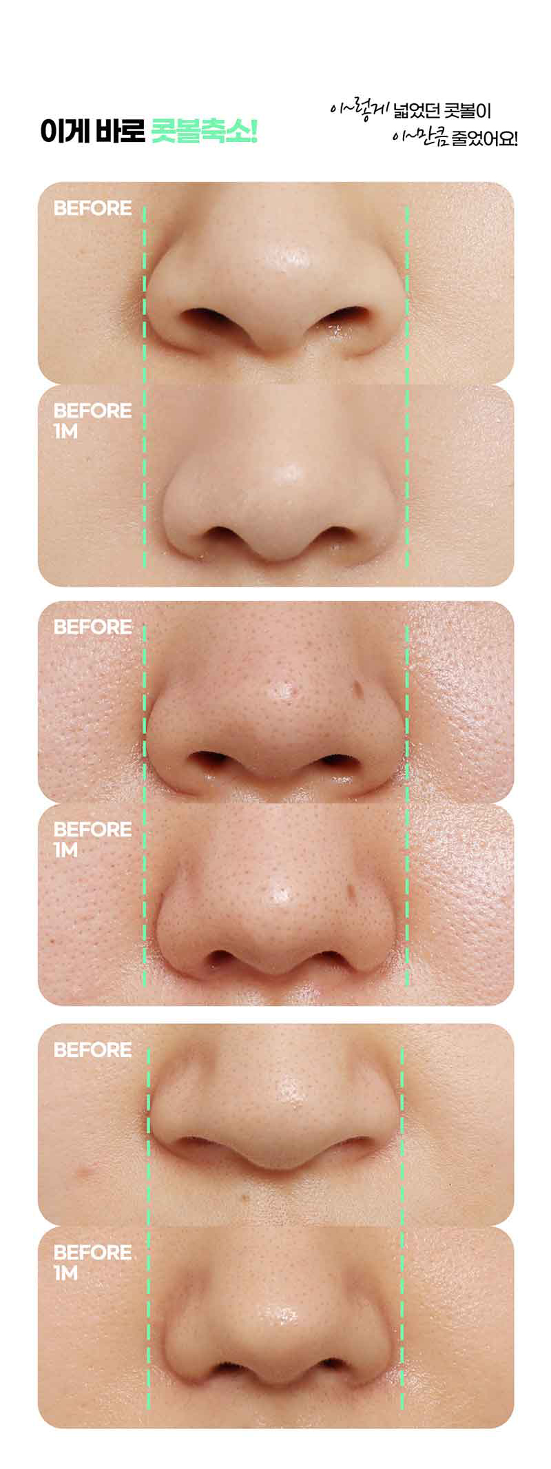 Looking into Nose Flare Reduction Reviews image 7