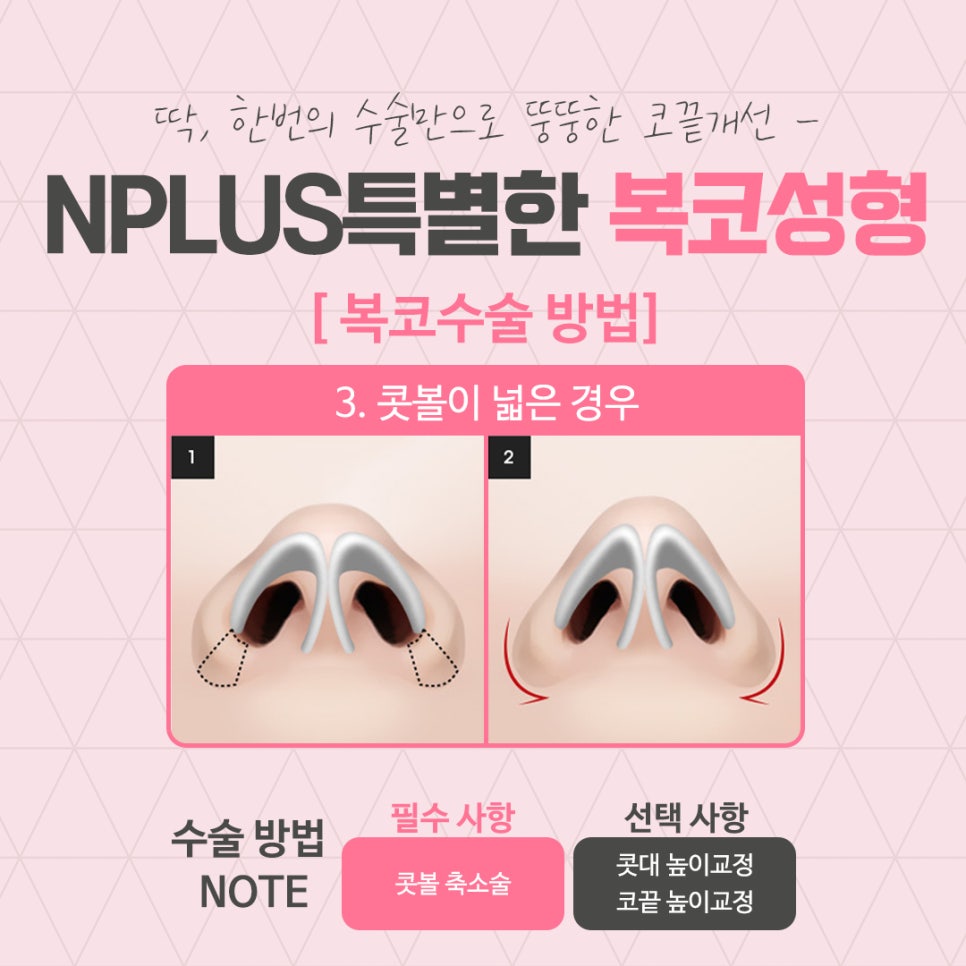 코지방제거를 통해 세련된 라인으로 관련 이미지 8