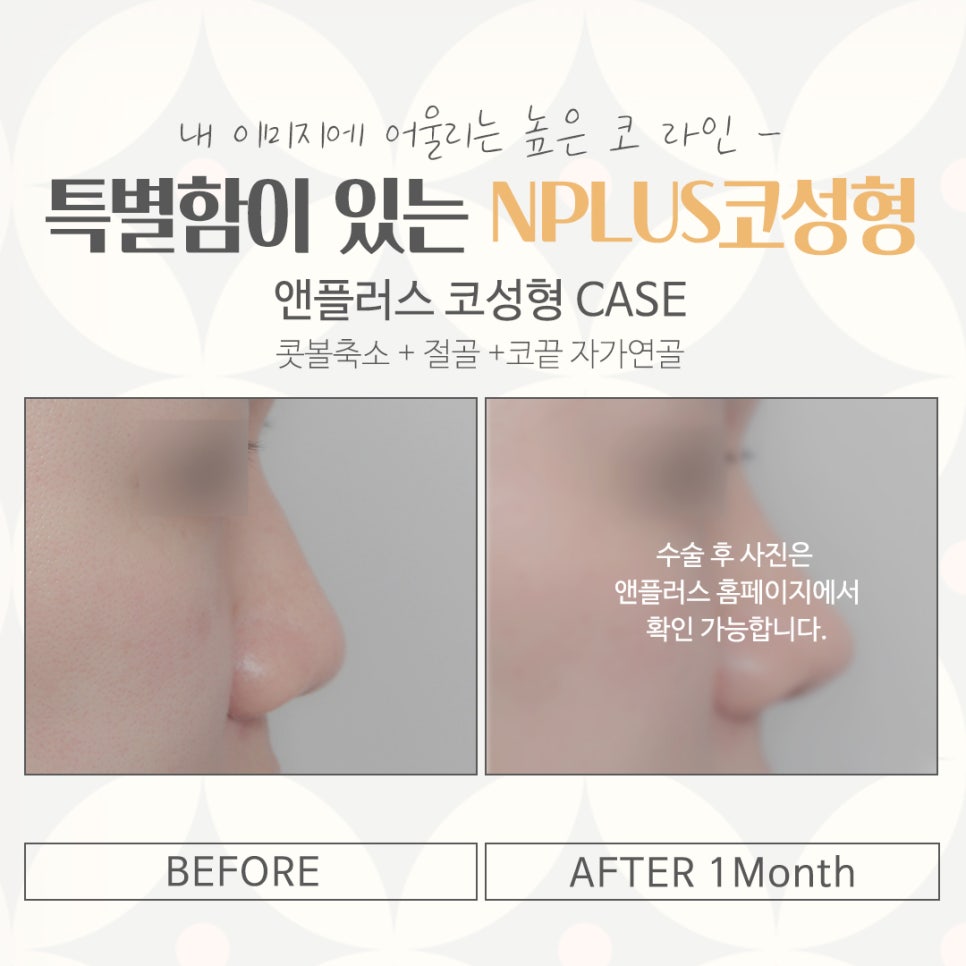 If You’re Looking for a Place That Does Rhinoplasty Well! image 14