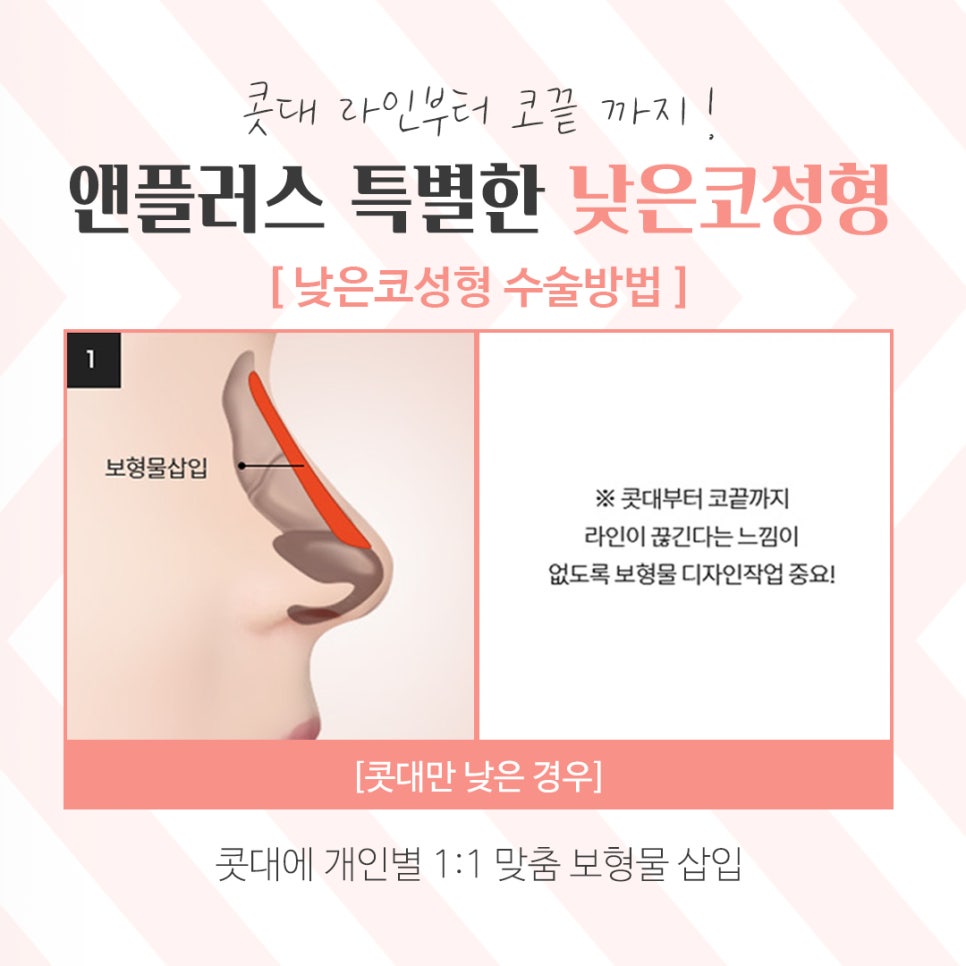 낮은코수술을 통해 날렵하고 세련된 이미지로 관련 이미지 8