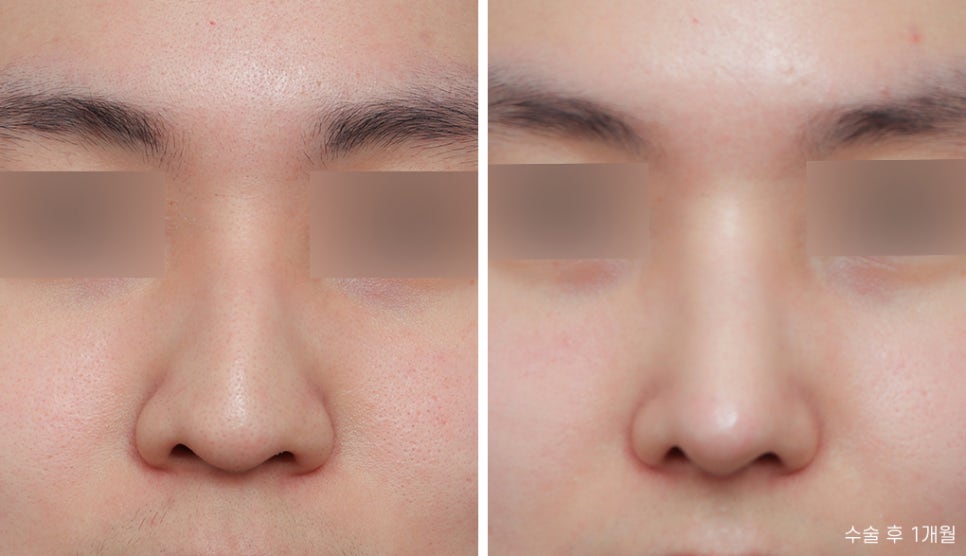 Hooked Nose Before-and-After Photos for a Softer Look image 3