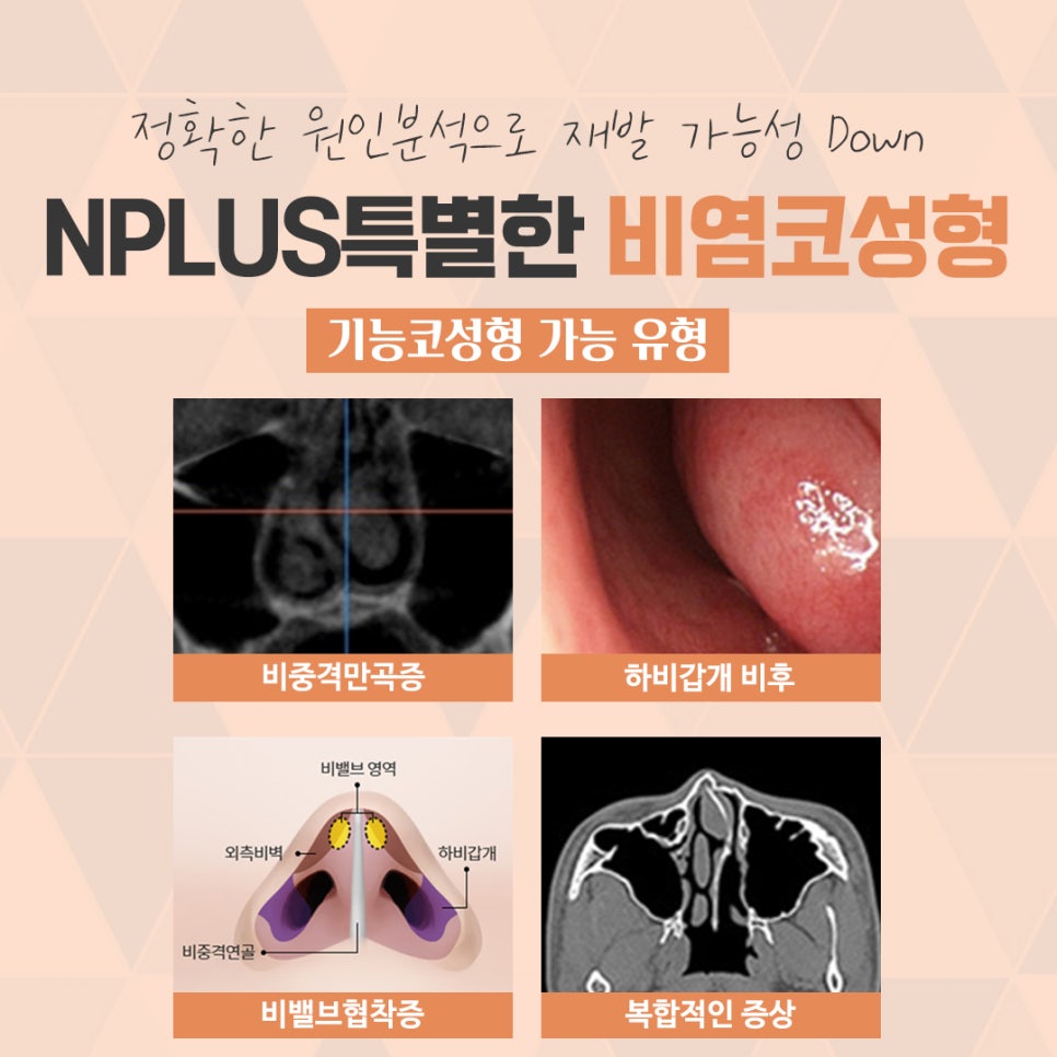 A Satisfying Result with One Rhinoplasty and Rhinitis Surgery image 5