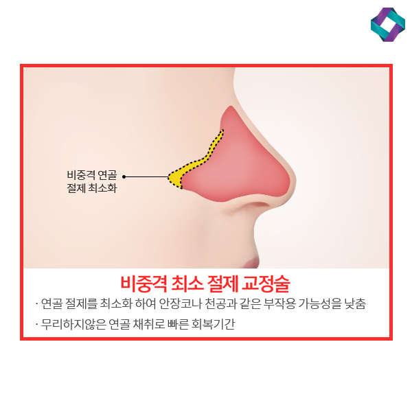 비염수술코성형 비밸브 교정술! 관련 이미지 3