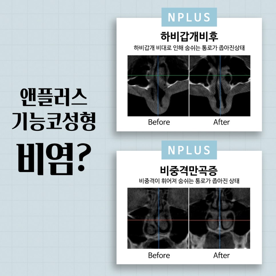 기능코성형비용을 다양하게 알아보고 관련 이미지 4