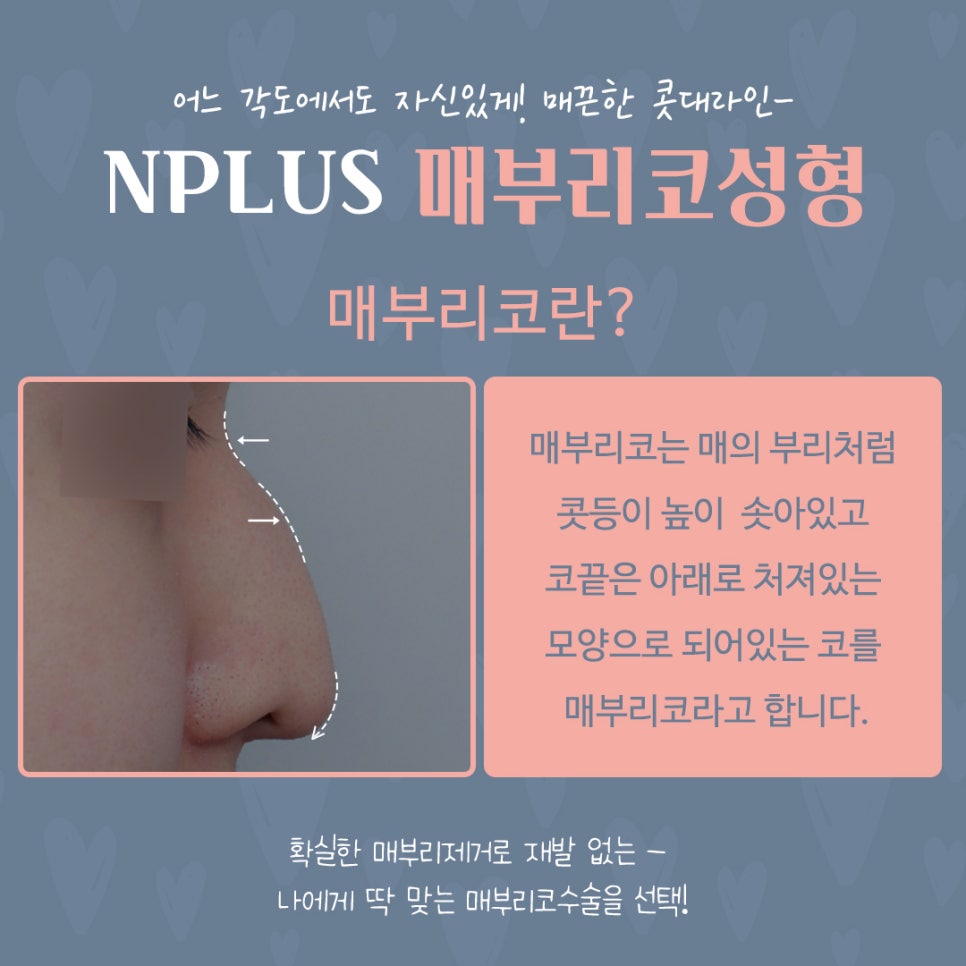 매부리코수술 후기까지 확인하고 관련 이미지 4