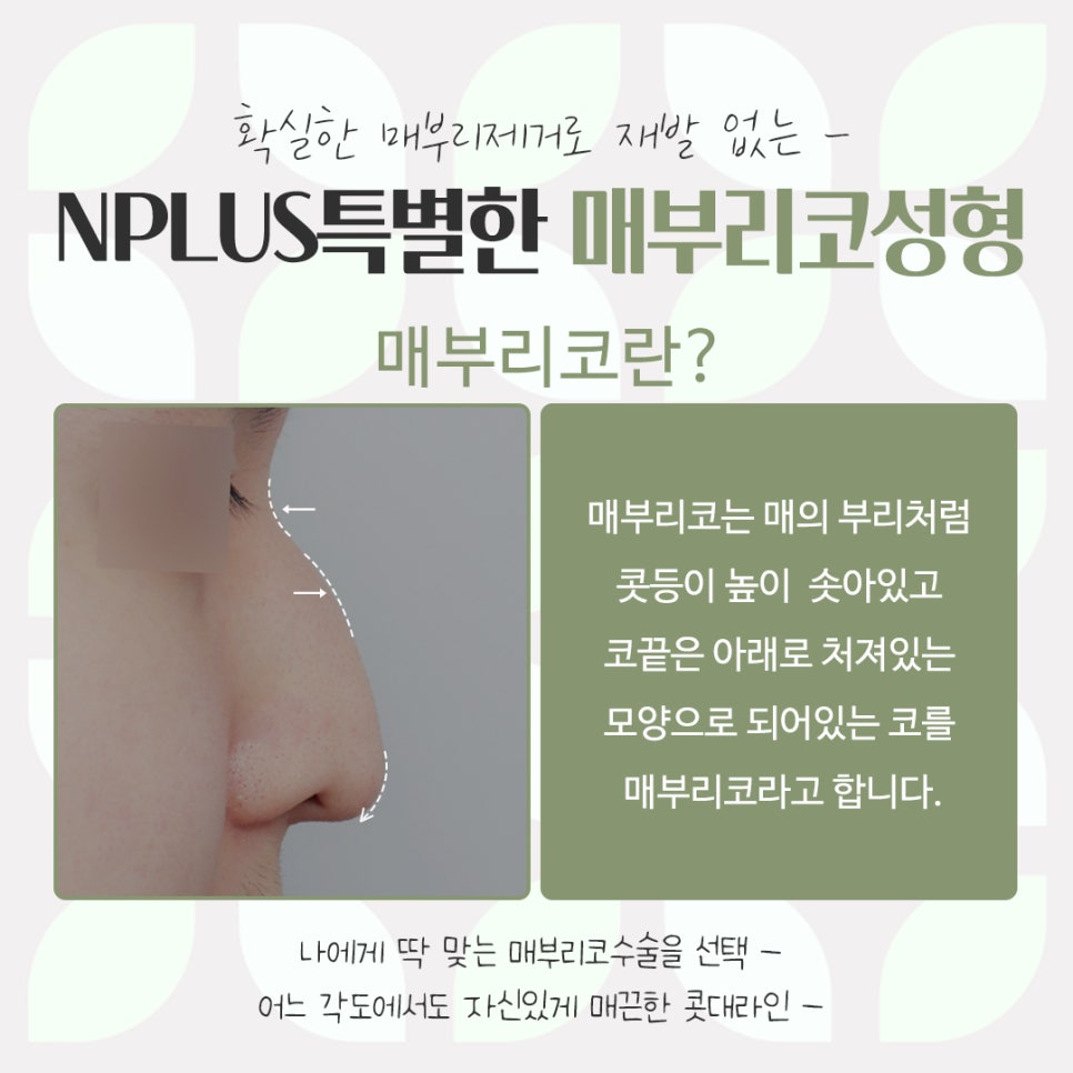 Detailed Hump Nose Surgery Review image 4