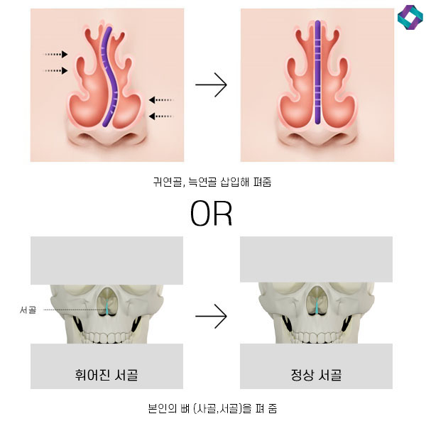 기능코성형 비중격만곡증(비중격교정술)과 코막힘원인 관련 이미지 10