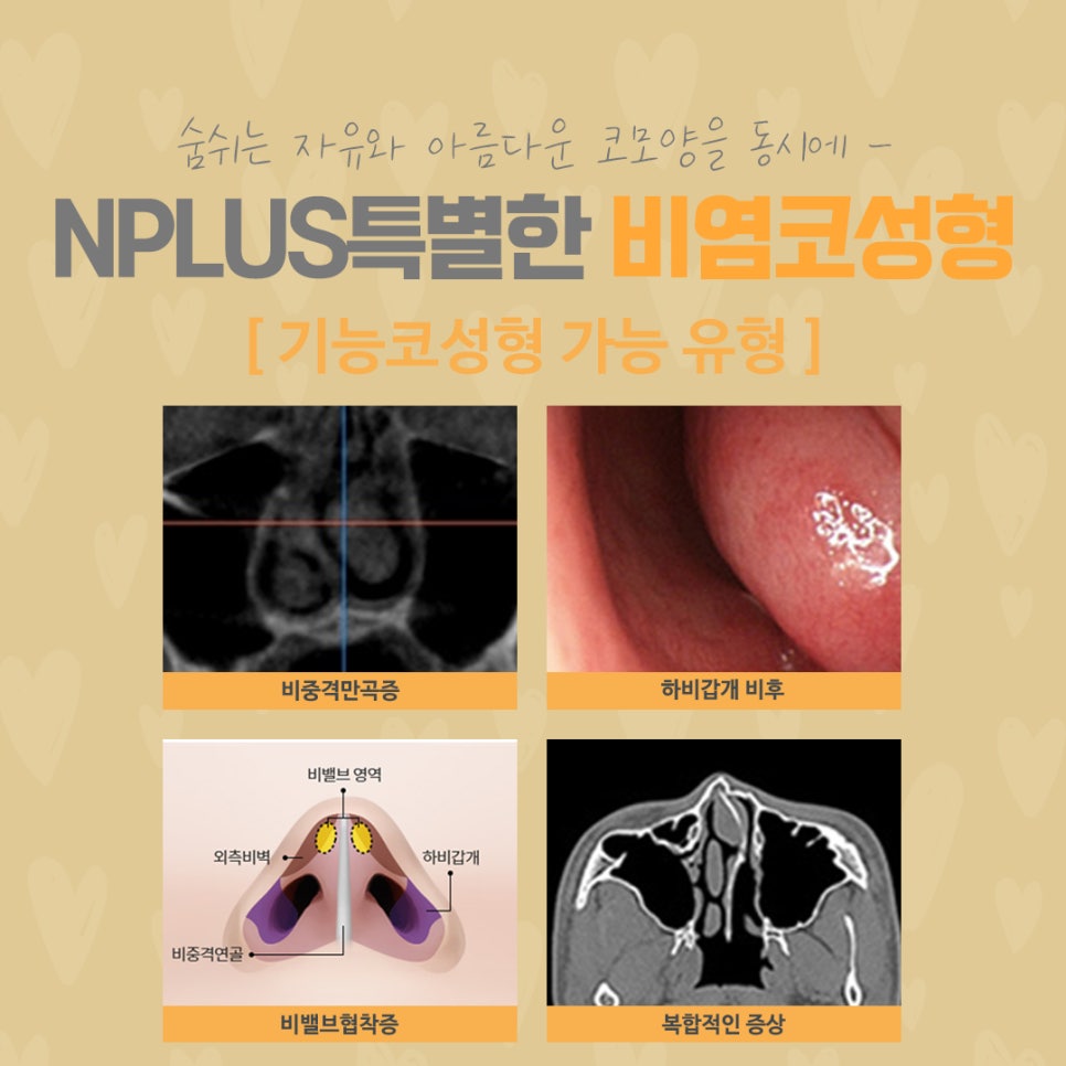 코막힘원인 정확하게 파악하는 것이 중요 관련 이미지 3