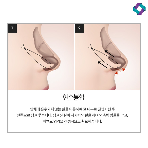 비염수술코성형 비밸브 교정술! 관련 이미지 9