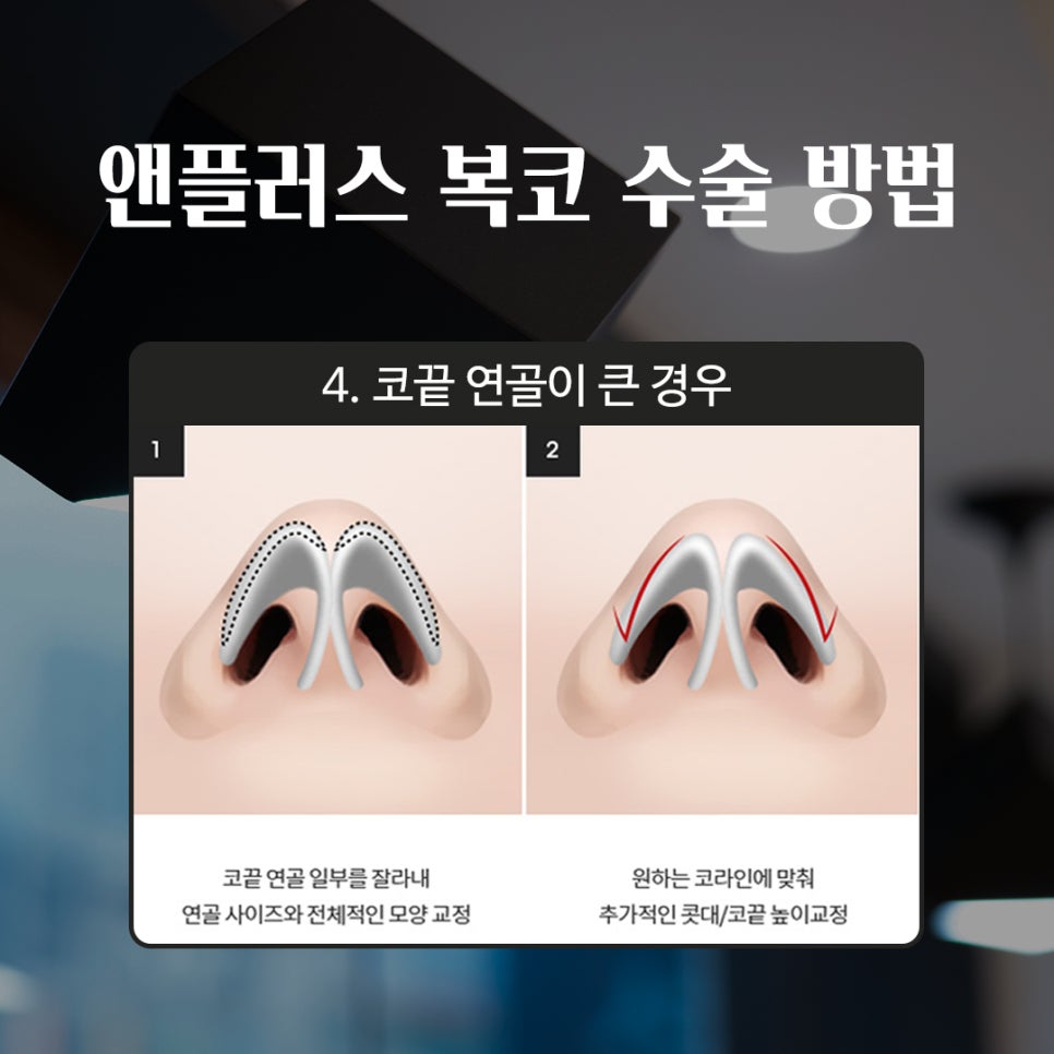 성형하기 힘든 코유형 관련 이미지 12