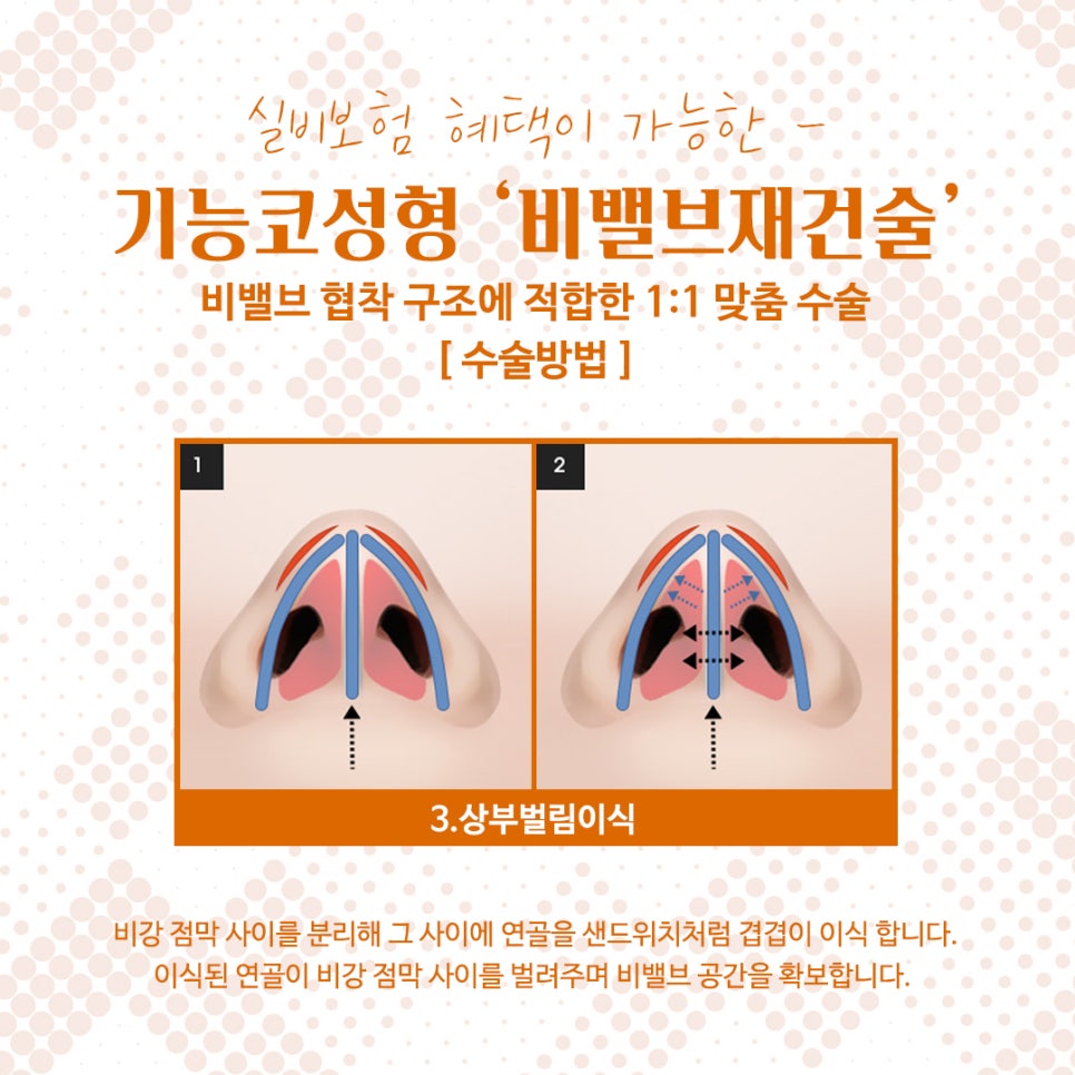 비밸브협착증 코수술방법 완벽 정리 관련 이미지 11