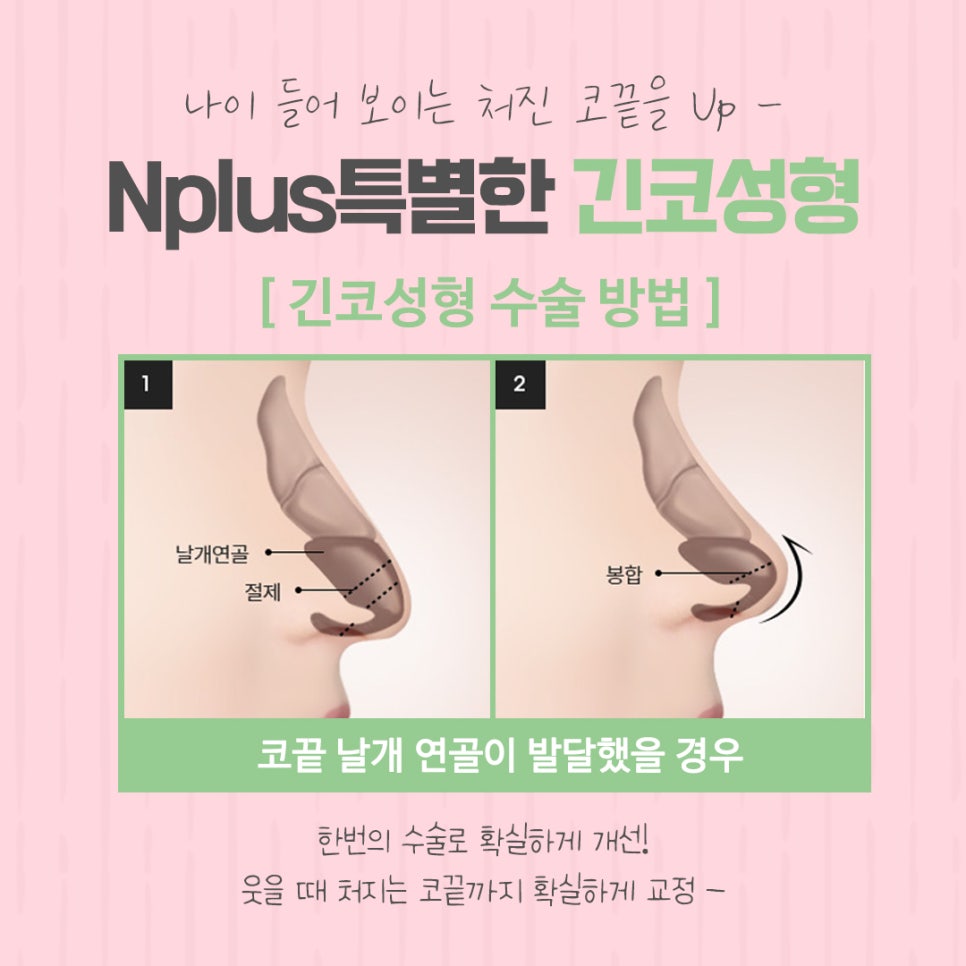 긴코성형으로 교정하고 동안 되자 관련 이미지 9