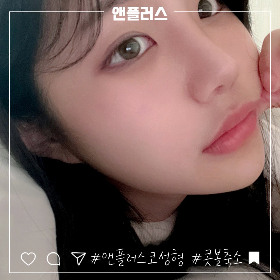 Choosing After Checking Rhinoplasty Alar Reduction Surgery Reviews image 4