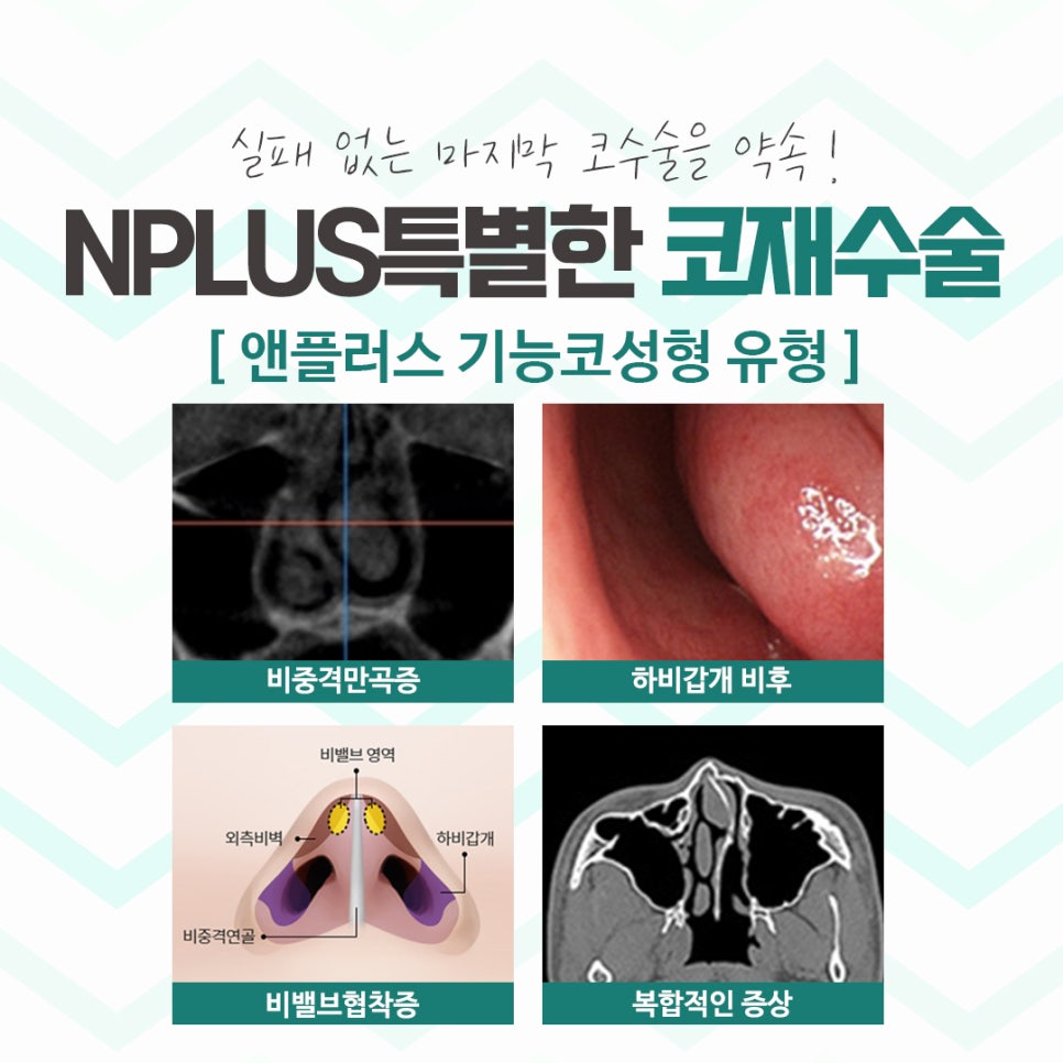 Male Nose Revision Surgery with a Thorough Diagnosis image 6