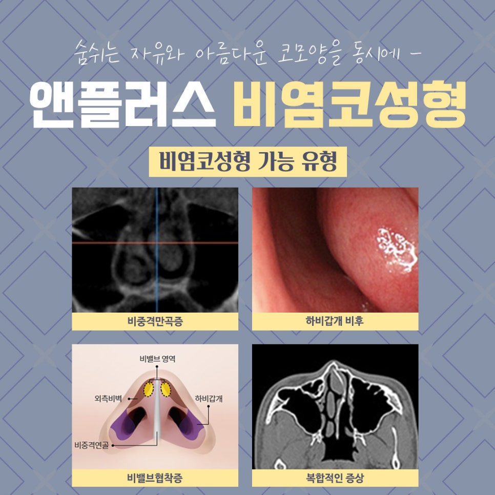 Review of Rhinoplasty for Rhinitis: Check and Decide image 5