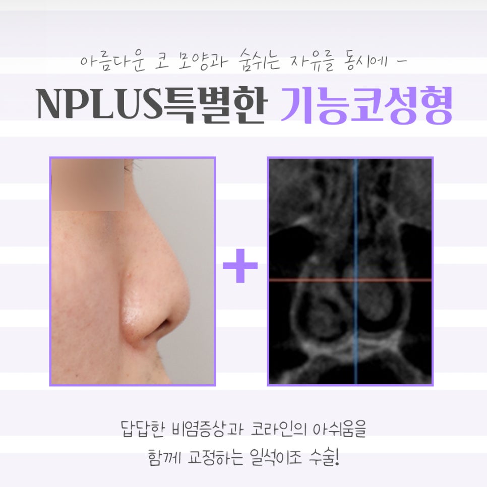 기능코성형후기 꼼꼼하게 체크하고 관련 이미지 4